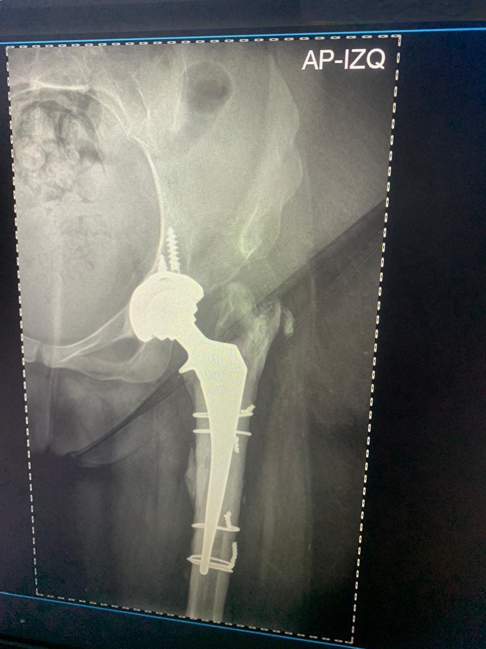 Radiografía postoperatoria de reemplazo total de cadera derecha exitoso - Dra. Ana Luz Bernabe